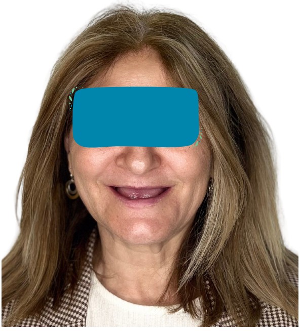 caso real zygomáticos Ammonite 01