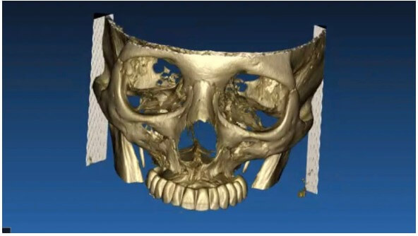 caso real zygomáticos Ammonite 02