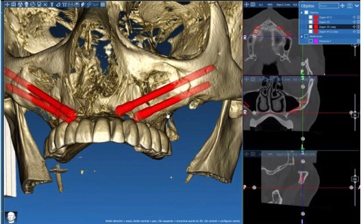 caso real zygomáticos Ammonite 04