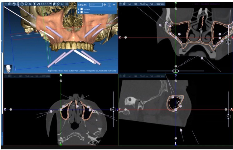 caso real zygomáticos Ammonite 05