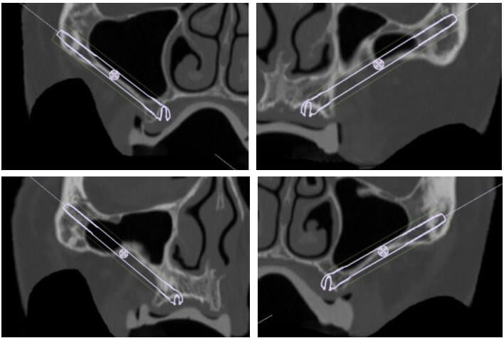 caso real zygomáticos Ammonite 06