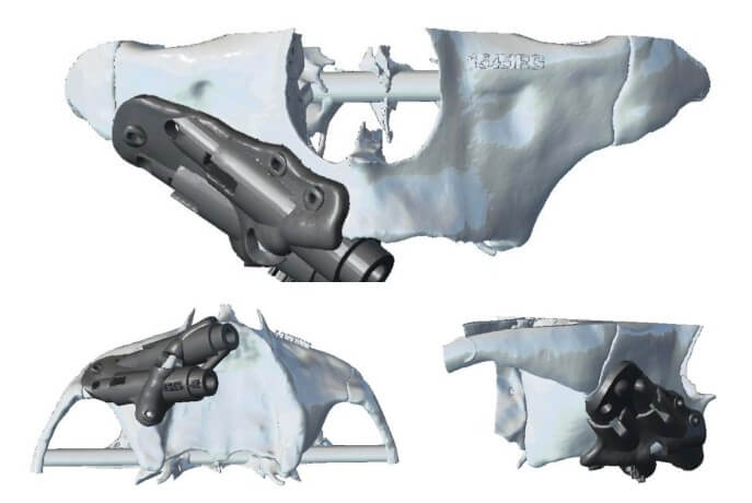 caso real zygomáticos Ammonite 07