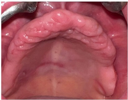 caso real zygomáticos Ammonite 09