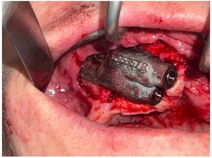 caso real zygomáticos Ammonite 11