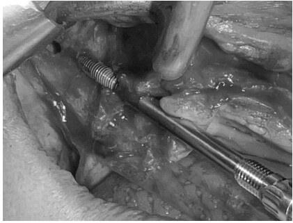 caso real zygomáticos Ammonite 12