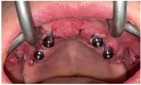 caso real zygomáticos Ammonite 13