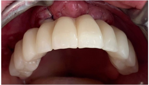 caso real zygomáticos Ammonite 16