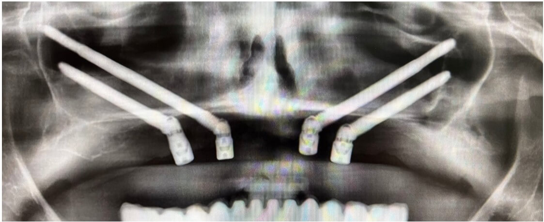 caso real zygomáticos Ammonite 17