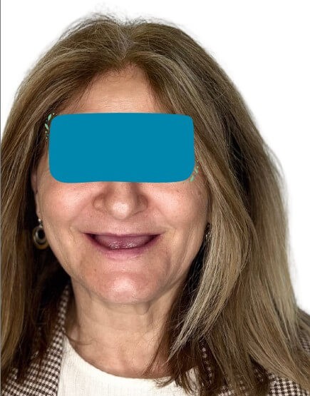 caso real zygomáticos Ammonite 18