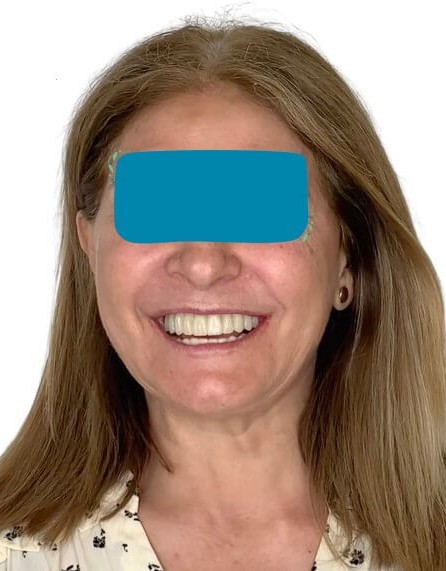 caso real zygomáticos Ammonite 19