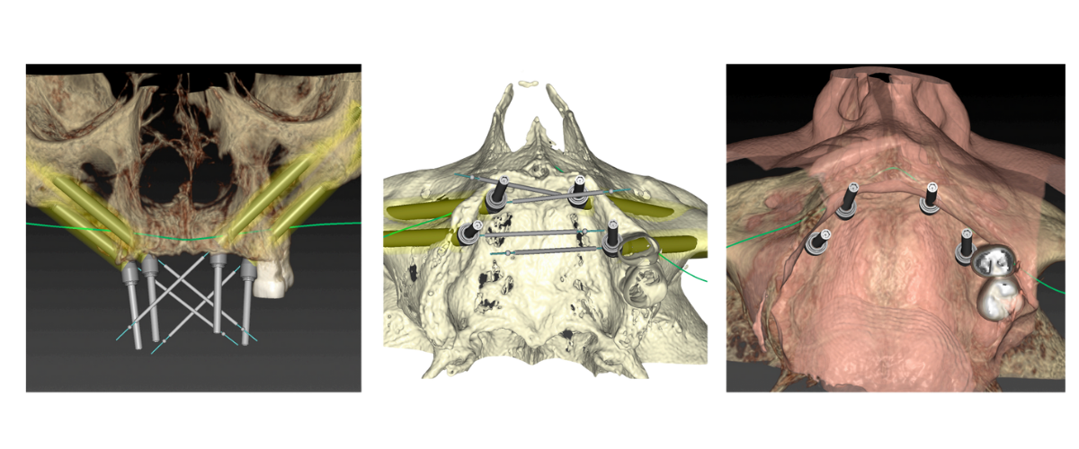 implantes-zigomáticos-madrid