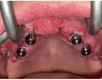 caso real zygomáticos Ammonite 13