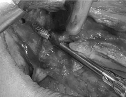 caso real zygomáticos Ammonite 12
