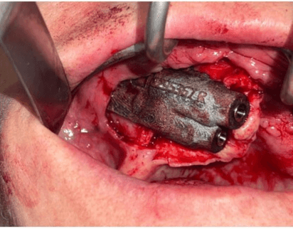 caso real de zygomáticos Ammonite 01