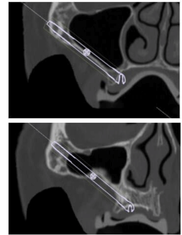 caso real de zygomaticos Ammonite 00001