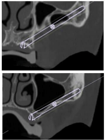 caso real de zygomaticos Ammonite 00002