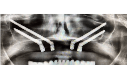 caso real de zygomáticos Ammonite 0001