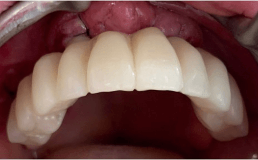 caso real zygomáticos Ammonite 16