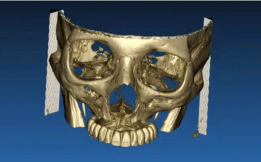 caso real de zygomáticos Ammonite 001